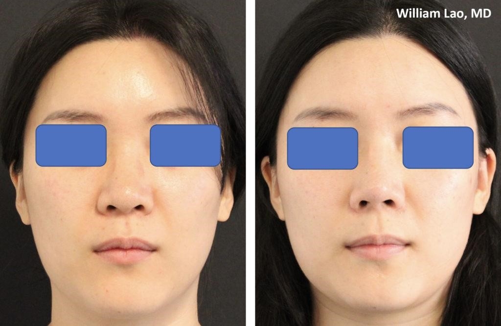 closed rhinoplasty near me