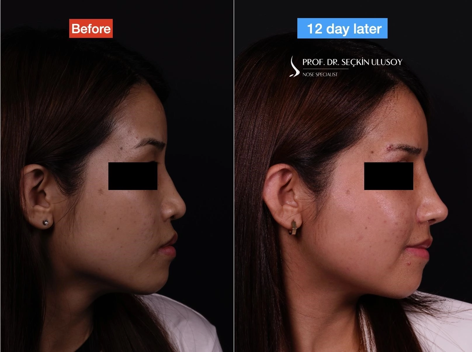 closed rhinoplasty near me