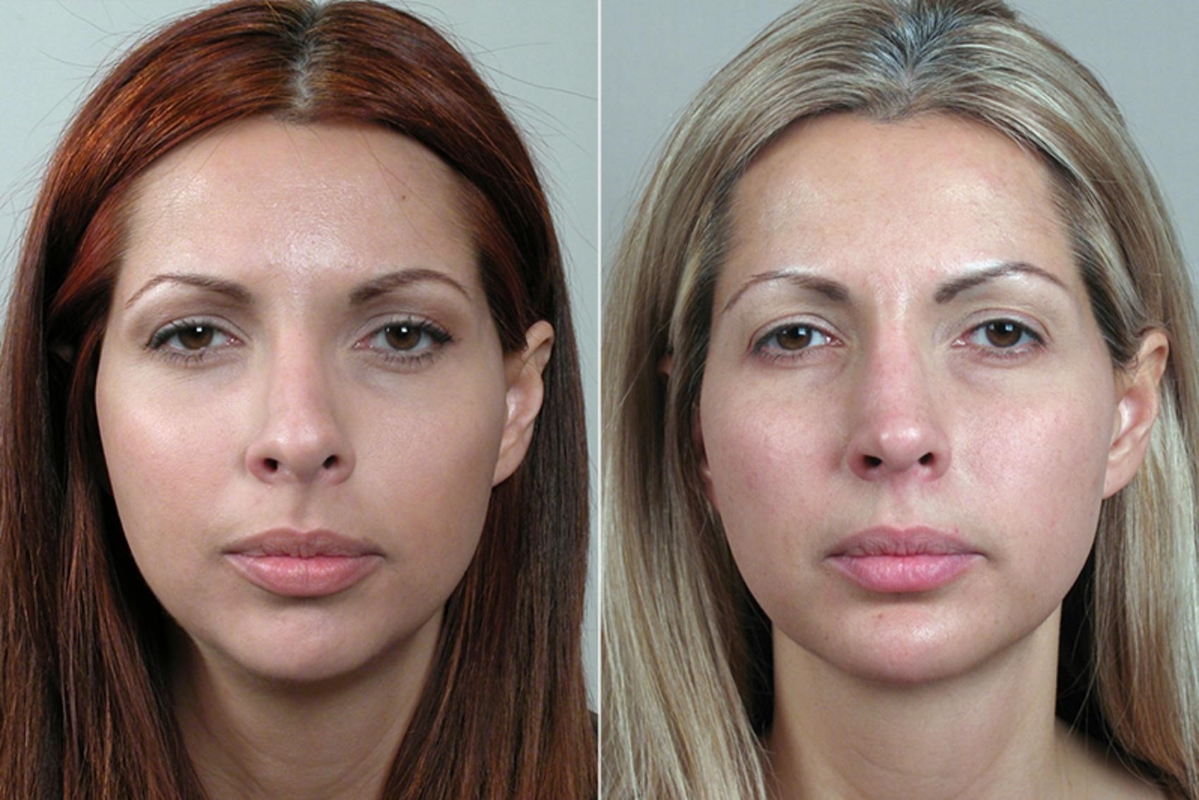 closed rhinoplasty near me